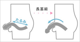 長茎術