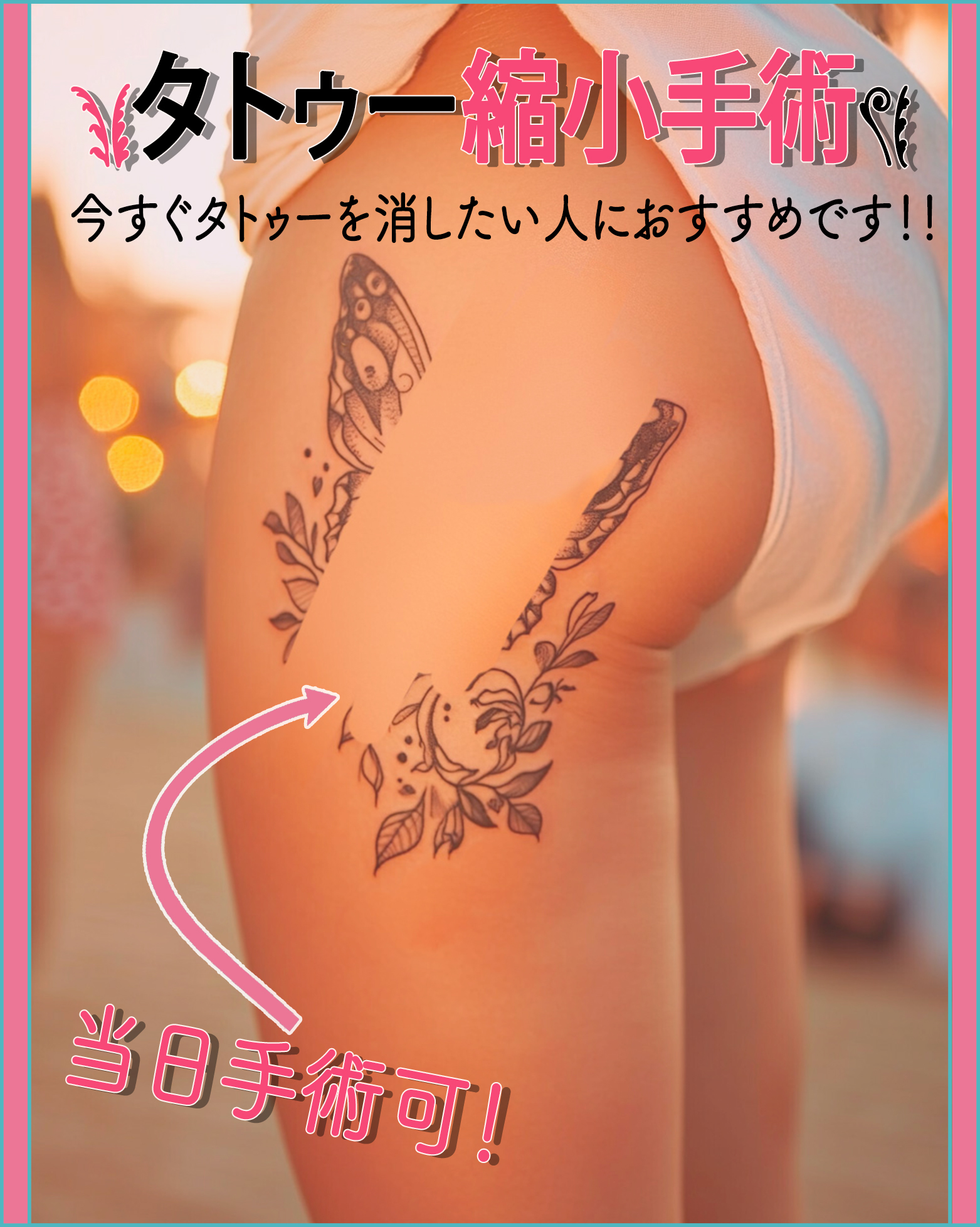 タトゥー縮小